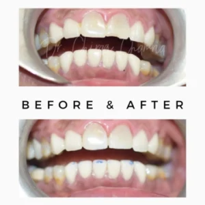 Smile Makeover result in one day