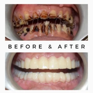 Before After Teeth Staining Treatment
