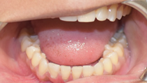 Posterior tooth dental Treatment