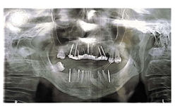 Xray of implants in mouth