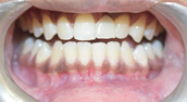 Front missing teeth replaced