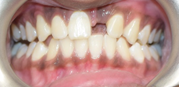 Single missing front tooth - Problem with Dental Implants