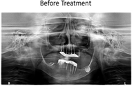 same day fixed teeth in virtually less or no bone