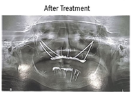 Zygomatic Dental implant