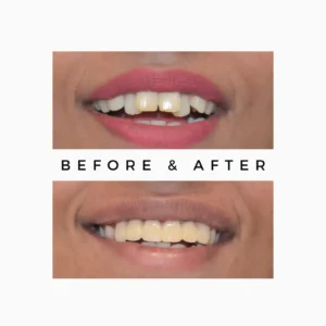 Crooked Smile Treatment