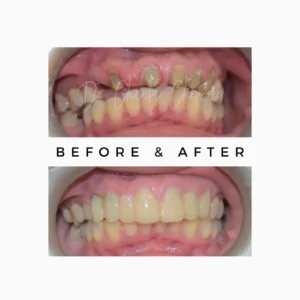 Full Mouth Cosmetic Smile Makeover in Mumbai