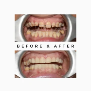 Brittle Teeth Treatment