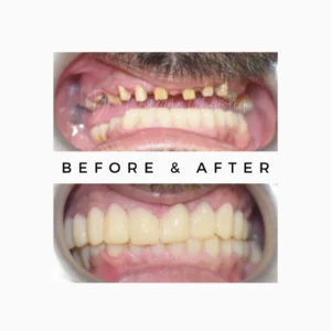 Full Mouth Rehabilitation