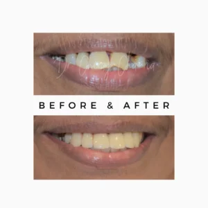 Cosmetic Dental Treatment