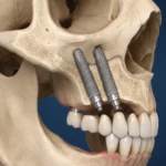 Zygomatic implant placement