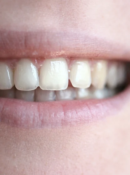 Same Day Fixed Teeth with Implant. Straight & Beautiful Teeth in 1 Day. Dental Implant