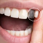 Discolored Tooth
