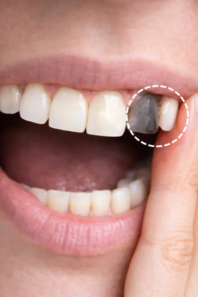 Discolored Tooth