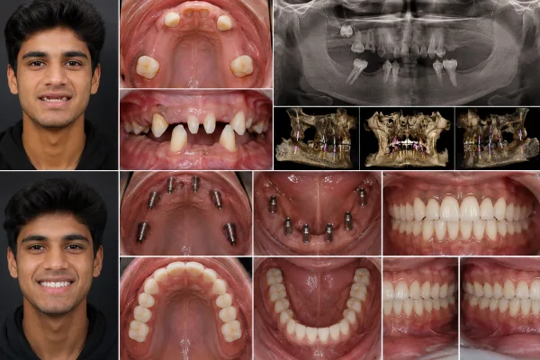 Full-Mouth Rehabilitation of an 18-Year-Old Male