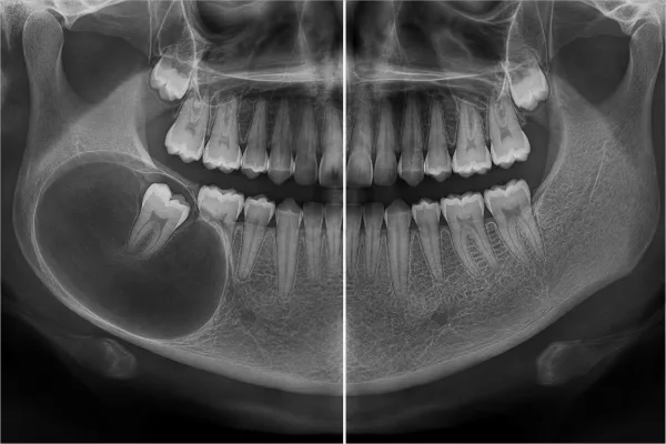 Long-Term Radiologic Healing After Enucleation of a Large Dentigerous Cyst