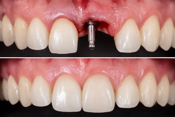 Role of monobloc dental implants in the rehabilitation of anterior dentoalveolar trauma