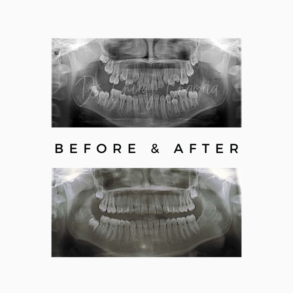 Wisdom Tooth Extraction