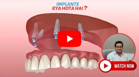 Same Day Fixed Teeth with Implant. Straight & Beautiful Teeth in 1 Day. Dental Implant
