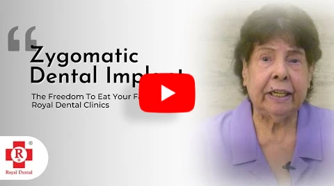 zygomatic dental implant