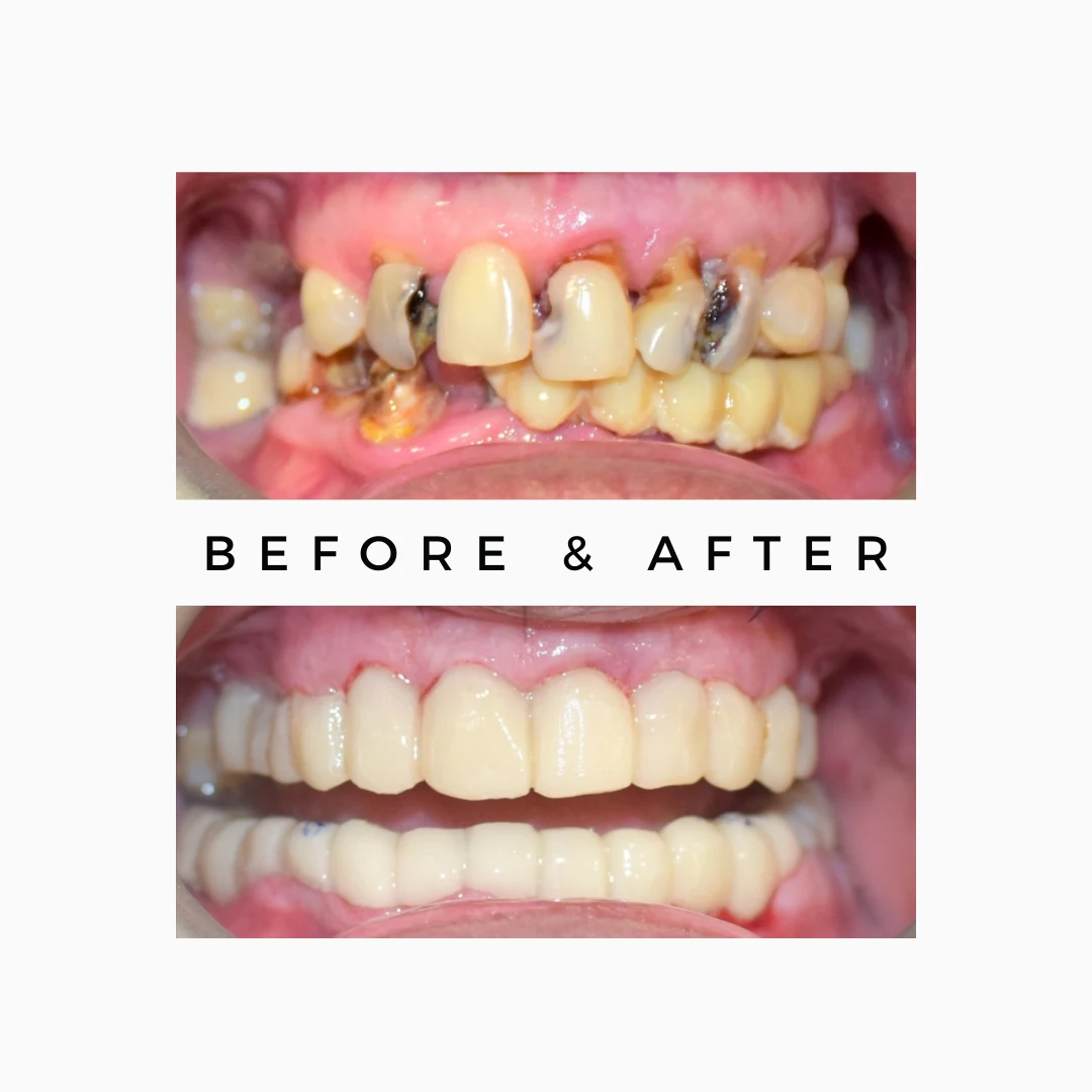 Gum Disease Treatment and Loose Teeth