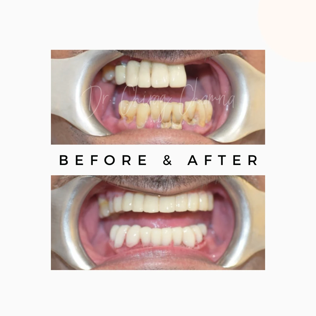 Dental Clinic in Mumbai | Royal Dental Clinics 3 Full Mouth Rehabilitation in Mumbai