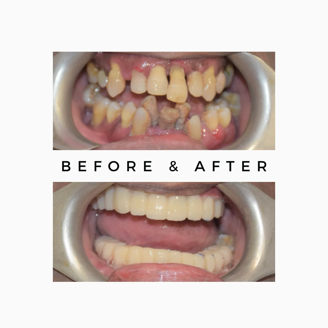 Tooth Mobility Treatment - Gingivitis