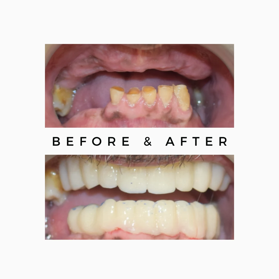 Dental Clinic in Mumbai | Royal Dental Clinics 2 Fixed Teeth with Dental Implants
