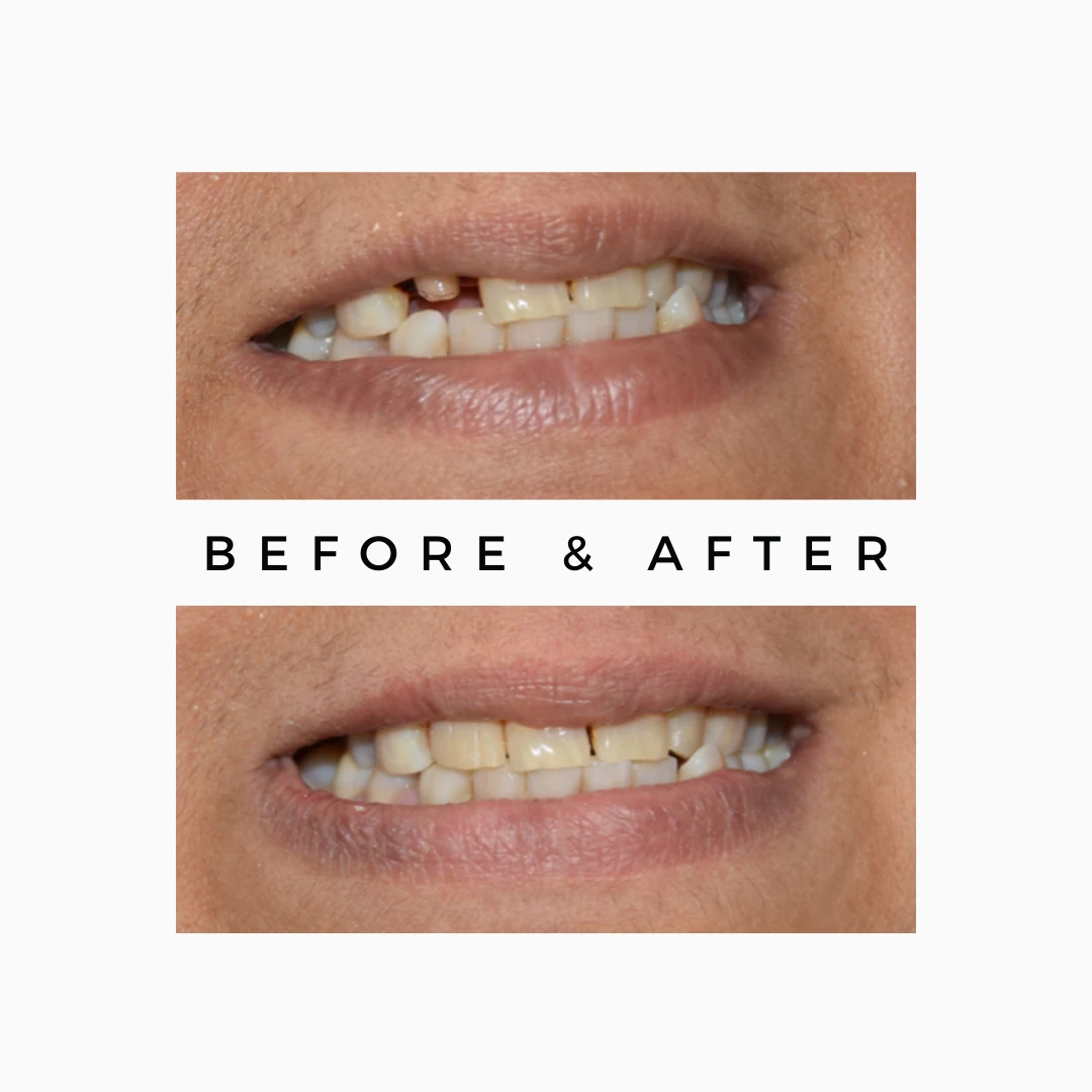 Dental Clinic in Mumbai | Royal Dental Clinics 5 Save Your Natural Teeth