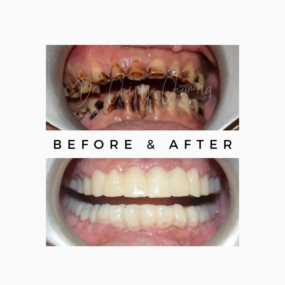 Save Natural Teeth 7 Teeth stains correction
