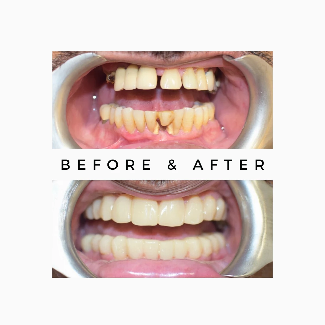 Save Natural Teeth 5 Root Canal Treatment in One Day