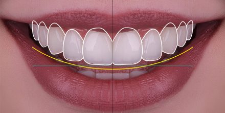 Gummy Smile Treatment