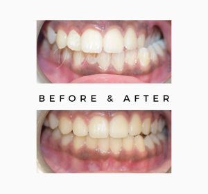 Teeth Straightening & Beautification