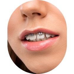 Braces and Aligners