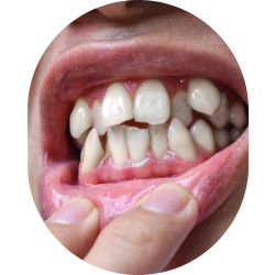 Crooked Teeth