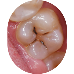 Filling Cavity