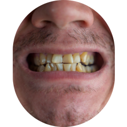 Full Mouth
