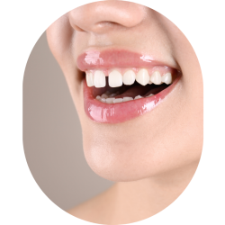 Gaps in teeth