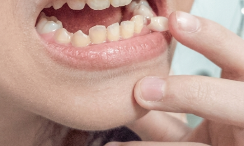 Moving teeth