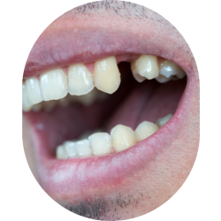 Missing Teeth