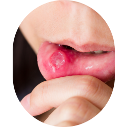 Mouth Ulcer