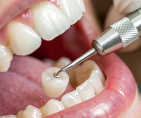 SAPTeeth™_ Designed to Protect, Not Just Replace