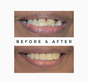 Royal Dental Clinics - Smile makeover
